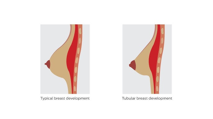 breasts shape