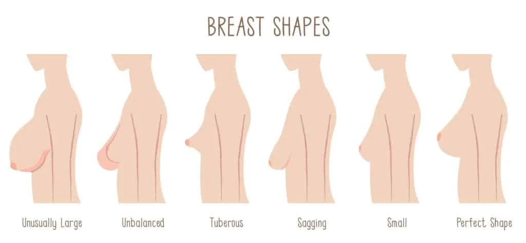 tubular breasts